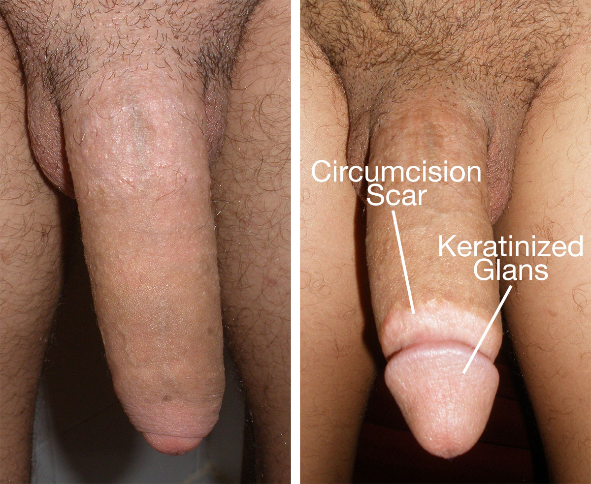 Circumcised and uncircumcised photos
